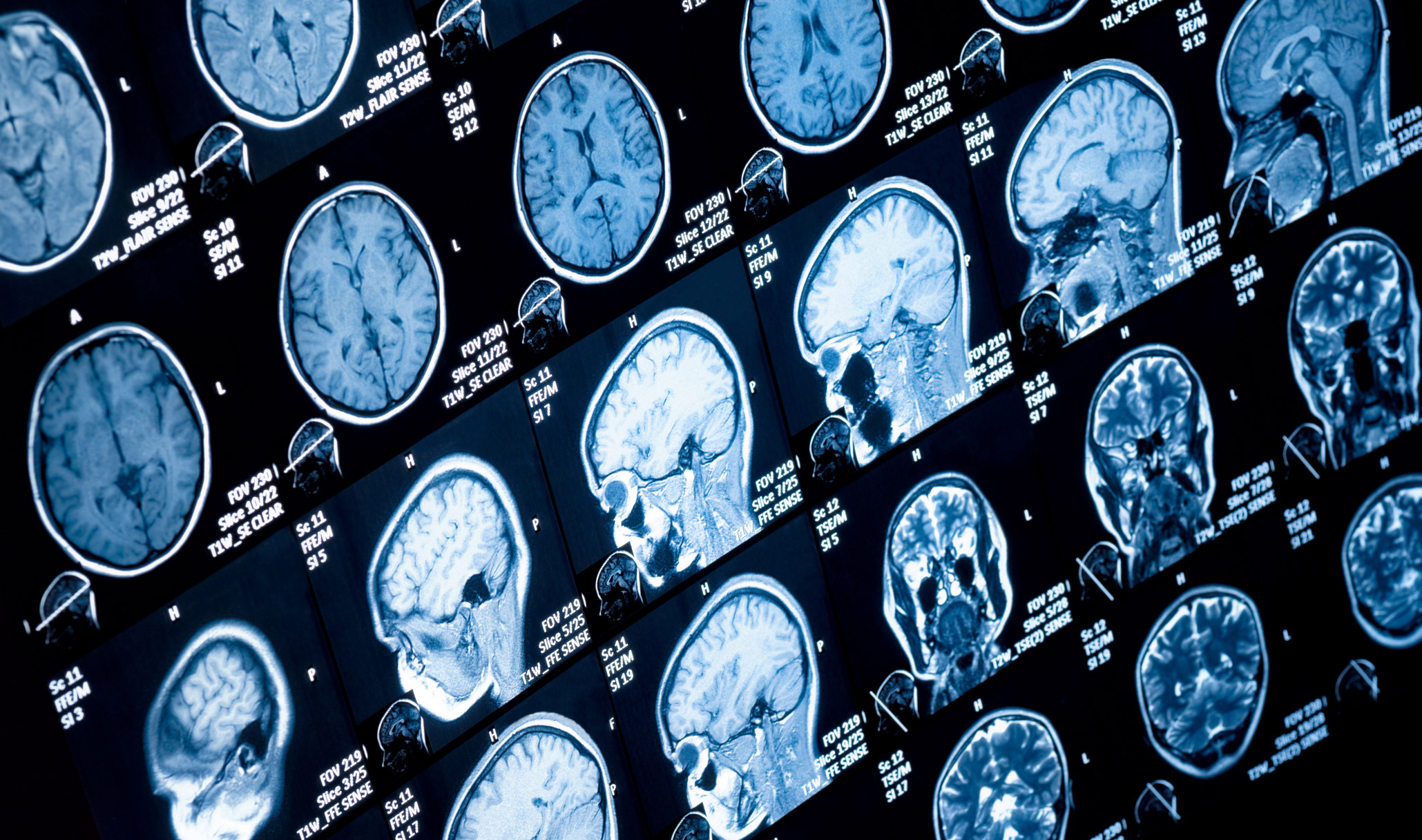 Key Visual: Brain Implant Gives New Hope to Epileptics FINEPLACER lambda 2, sub-micron bonder, µLED components, brain implants, prototyping, soldering, adhesive, ultrasonic